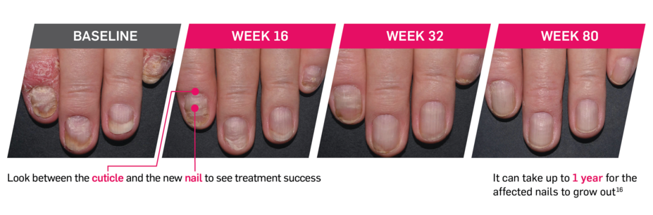 Baseline vs Week 16, Week 32, and Week 80 patient photos taken during PsO trials. Look between the cuticle and the new nail to see treatment success. It can take up to 1 year for the affected nails to grow out.