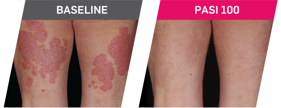 Baseline vs PASI 100 patient photos taken during PsO clinical trials.