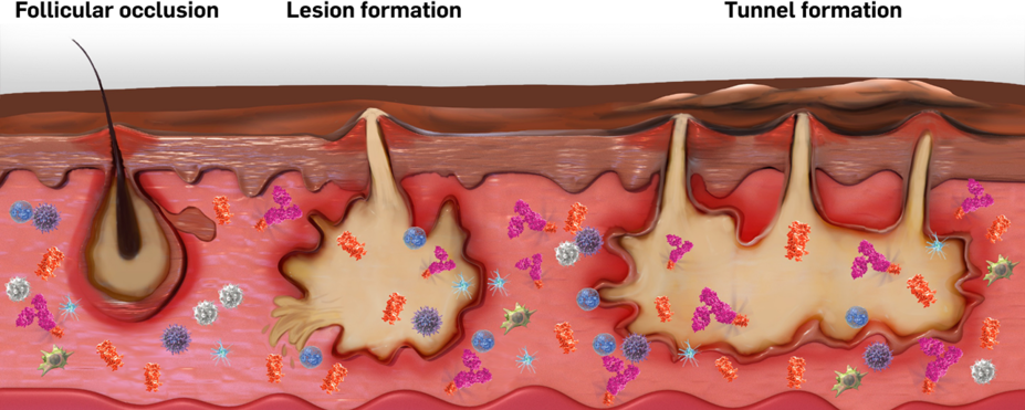 COSENTYX mechanism of action in HS