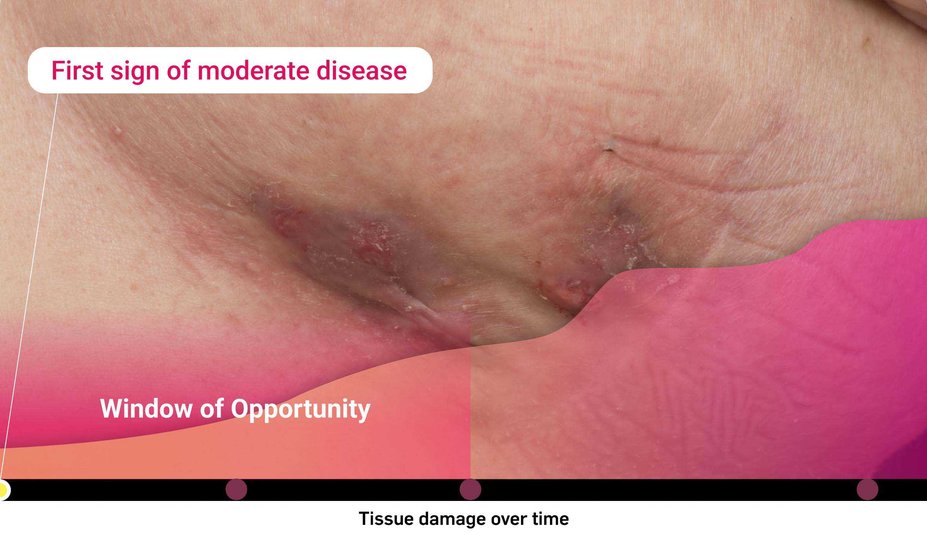 First sign of moderate disease. Window of Opportunity. Tissue damage over time