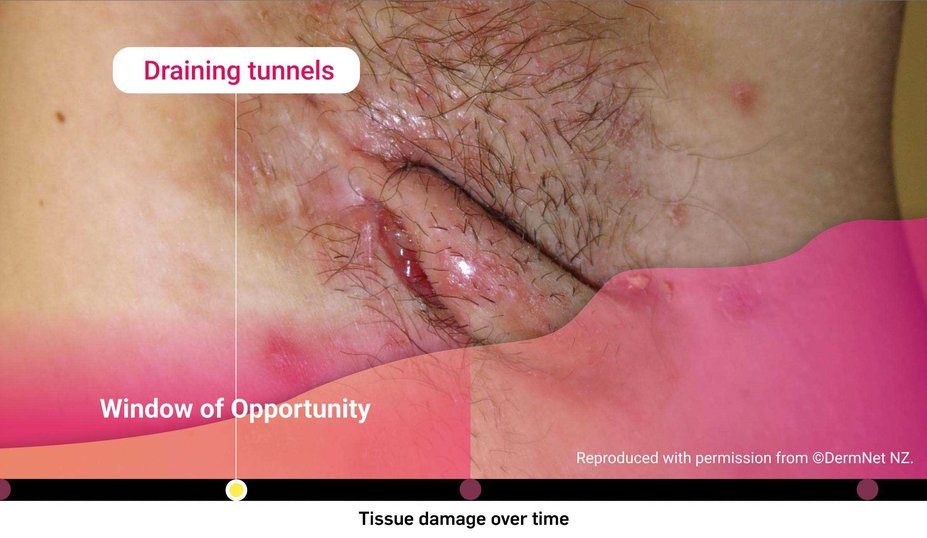 Draining tunnels. Window of Opportunity. Tissue damage over time.