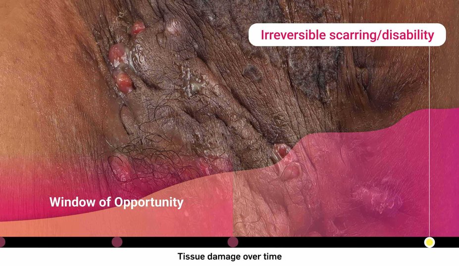 Irreversible scarring/disability. Window of Opportunity. Tissue damage over time.