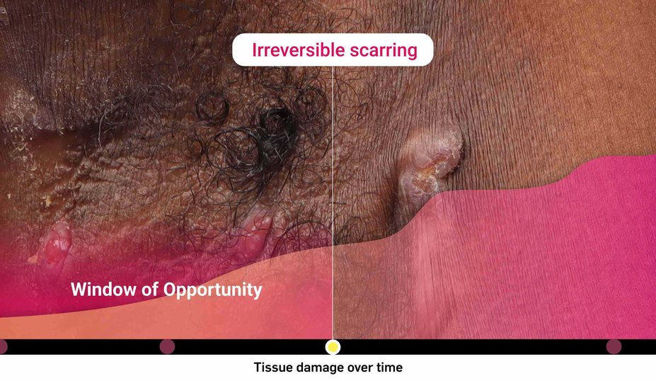 Irreversible scarring. Window of Opportunity. Tissue damage over time.