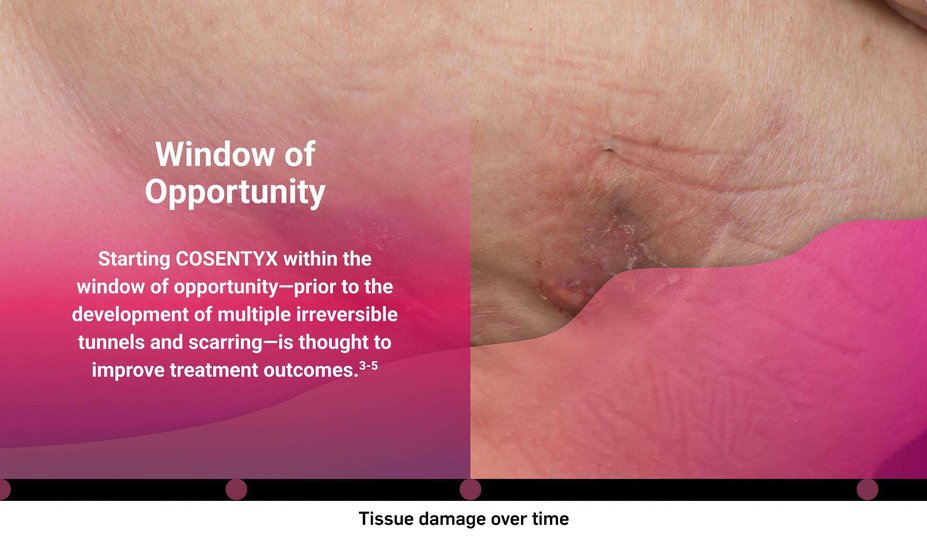 Window of Opportunity. Starting COSENTYX within the window of opportunity-prior to the development of multiple irreversible tunnels and scarring-is thought to improve treatment outcomes.