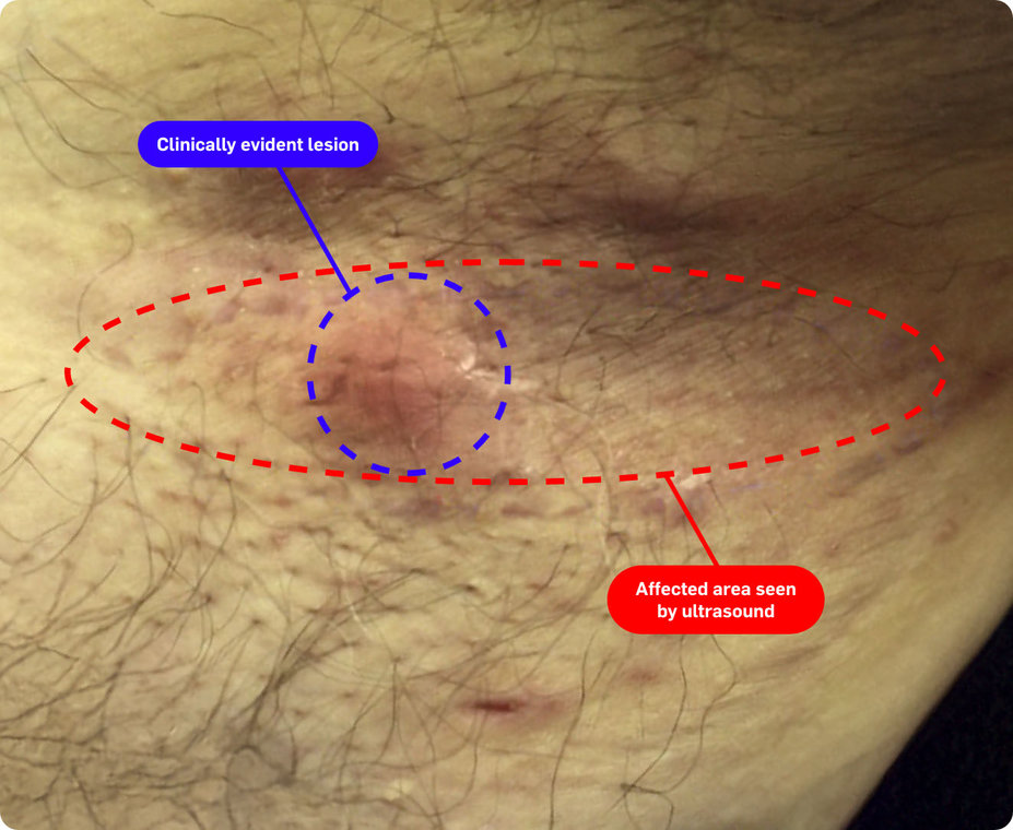 Long erythematous lesion in the armpit. Clinically evident area. Area seen by ultrasound.