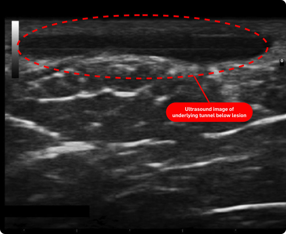 Ultrasound image showing underlying fistulous tract.
