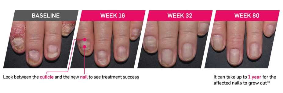 Baseline vs Week 16, Week 32, and Week 80 patient photos taken during PsO trials. Look between the cuticle and the new nail to see treatment success. It can take up to 1 year for the affected nails to grow out.