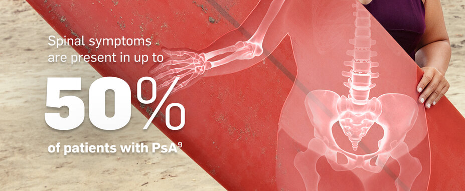 Spinal symptoms are present in up to 50% of patients with PsA