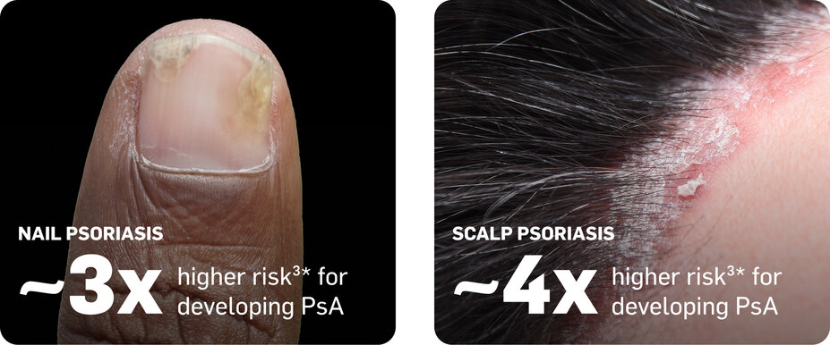 Nail psoriasis ~3x higher risk for developing PsA. Scalp psoriasis ~4x higher risk for developing PsA.