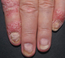 Relief of nail symptoms baseline