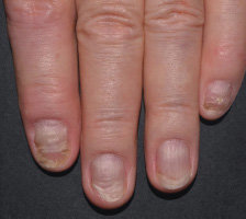 Relief of nail symptoms on week 16