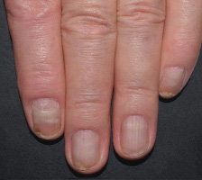 Relief of nail symptoms on week 32.