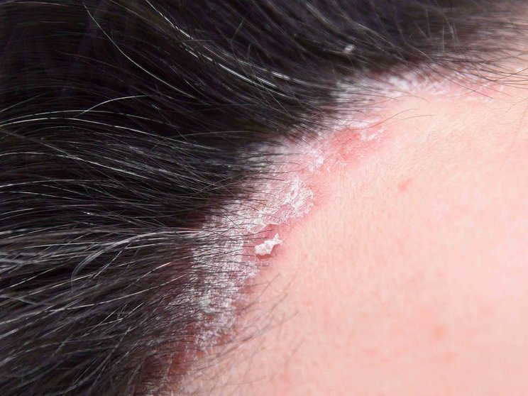 Psoriasis on the scalp