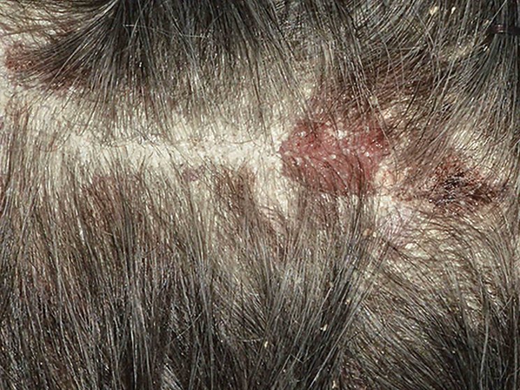 Scalp at baseline