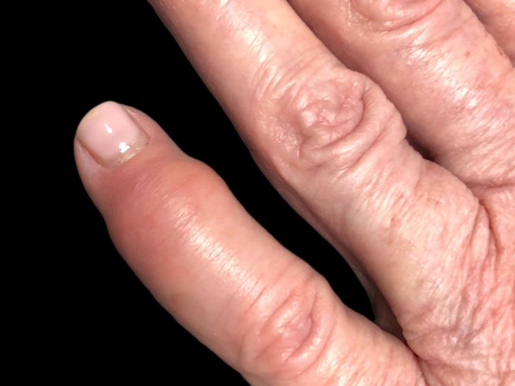 Dactylitis manifestation of PsA