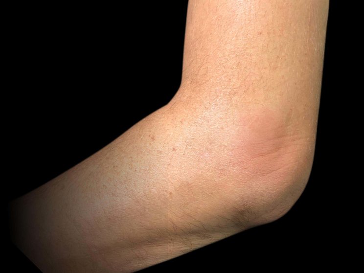 Enthesitis manifestation of PsA