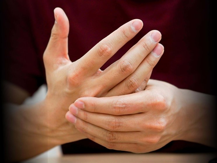 Joint manifestation of PsA