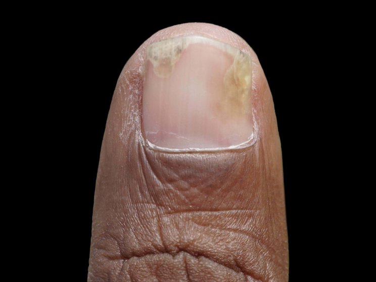 Nail manifestation of PsA