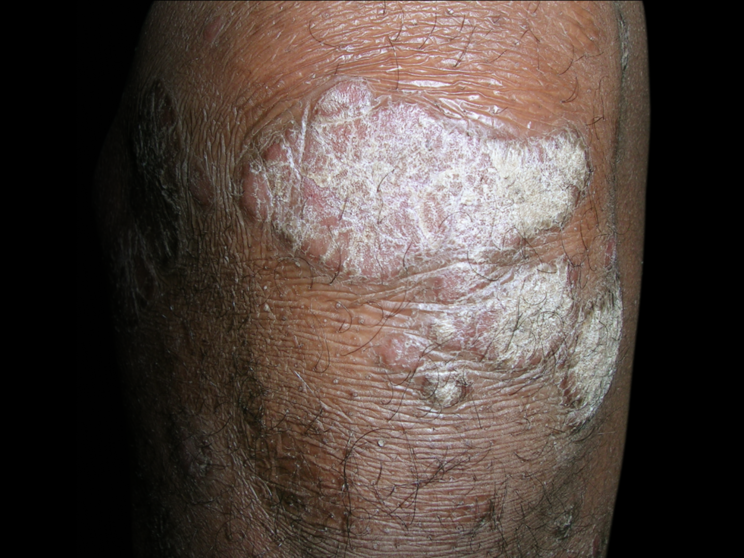 Skin manifestation of PsA