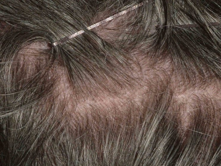 Scalp at Week 12